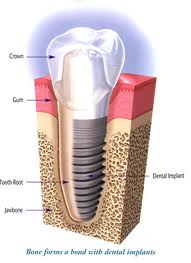 Burbank dentist | Dental implants | Dr Ananian