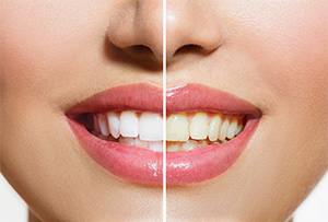 Burbank dentist | teeth whitening | Dr. Ananian | 